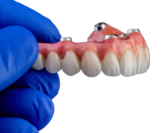 Prótese protocolo sobre implantes